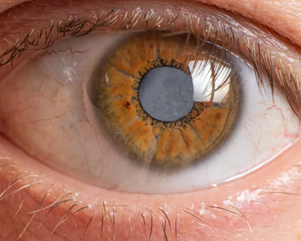 Glaucoma Awareness