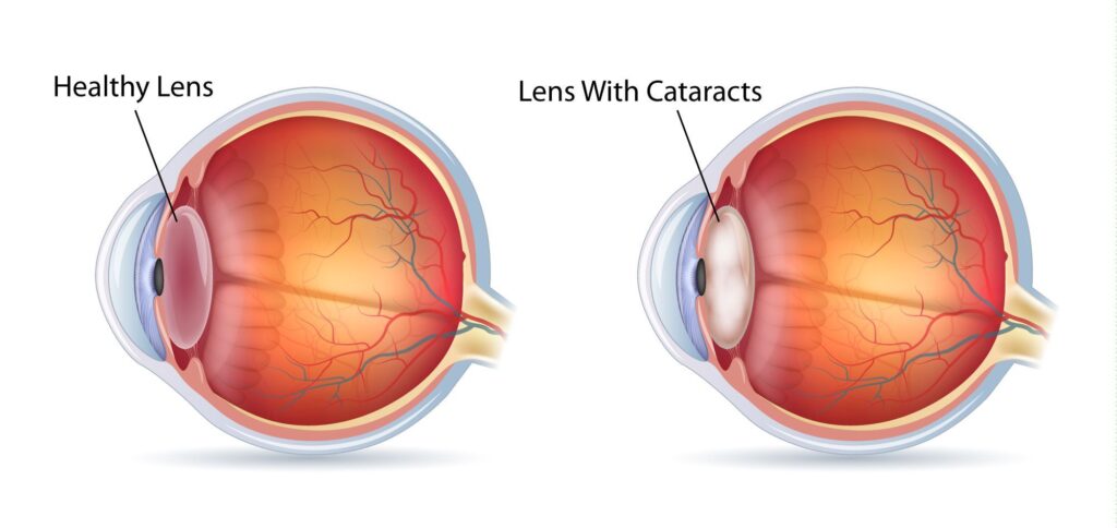 Benefits of Cataract Surgery