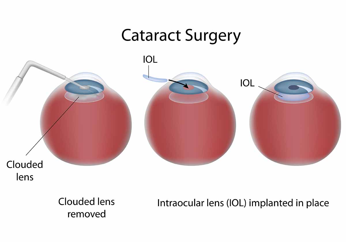 Risks of Cataract Surgery