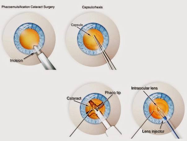 Cataract Treatment Options