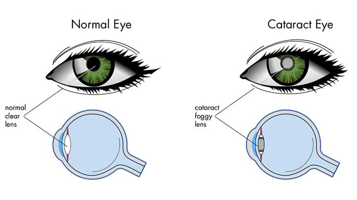 What are Cataracts
