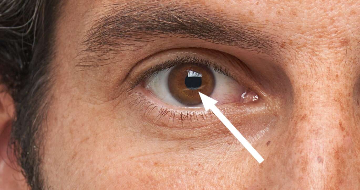 Causes of Corneal Damage