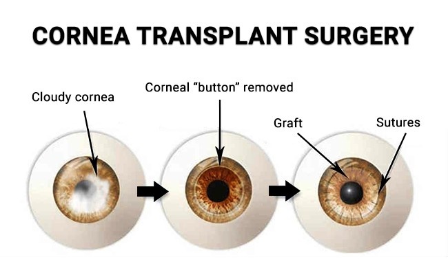 Cornea Surgery Recovery