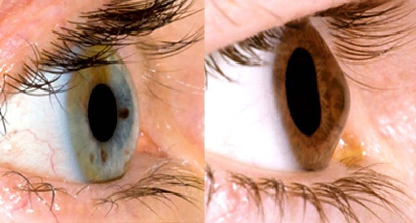 Symptoms of Corneal Disease