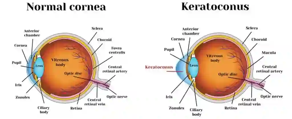 What is Corneal Disease