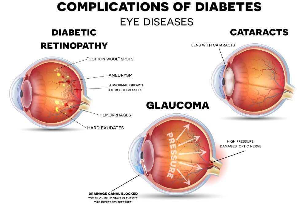 Causes of Diabetic Eye Problems