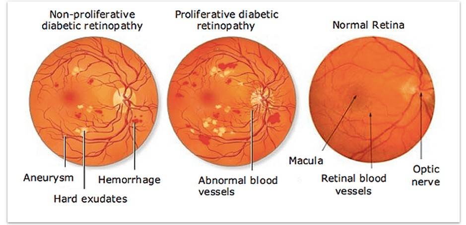 Diabetic Eye Conditions