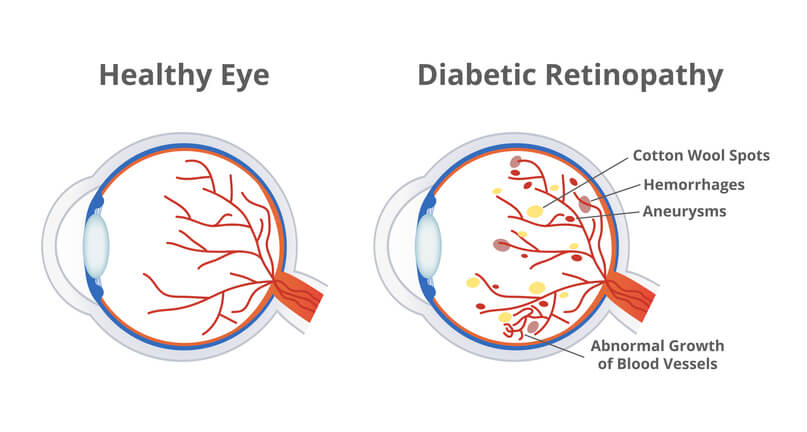 Treatment Options for Diabetic Eye Care