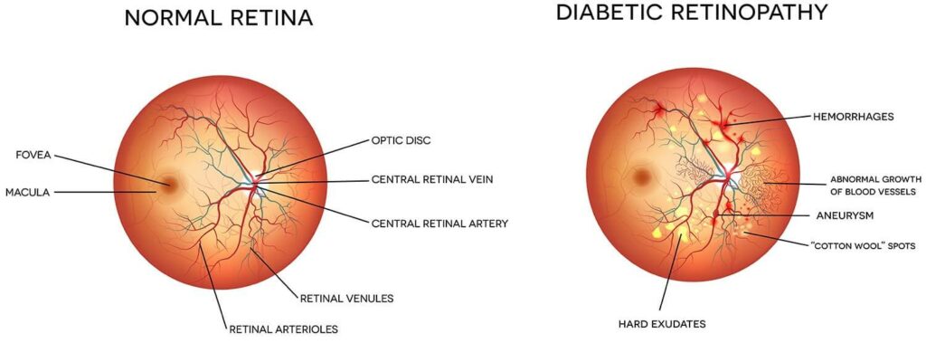 What is Diabetic Eye Care