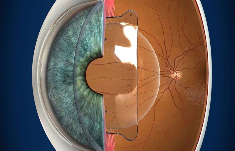 ICL Surgery
