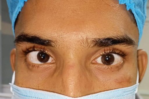 Squint Surgery