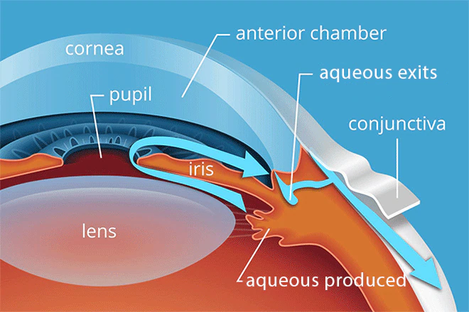 Causes of Glaucoma