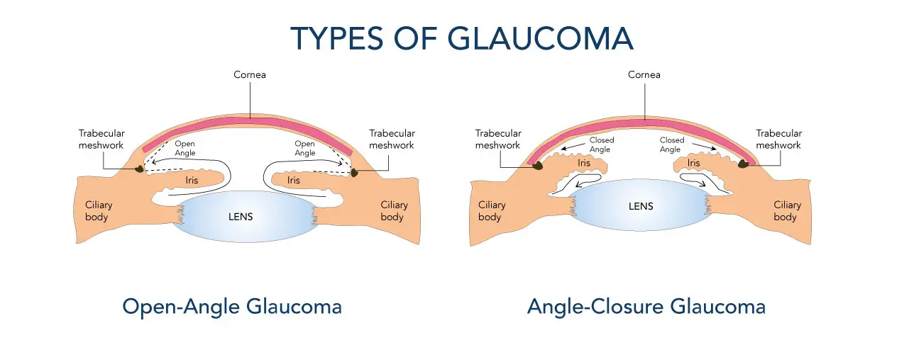 Types of Glaucoma