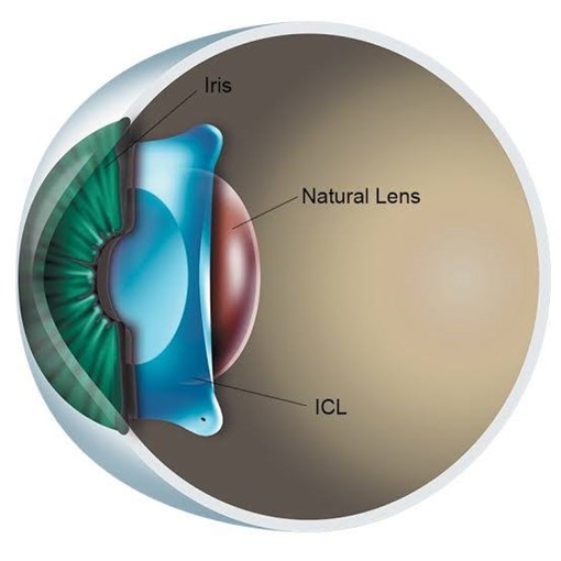 Candidate for ICL Surgery