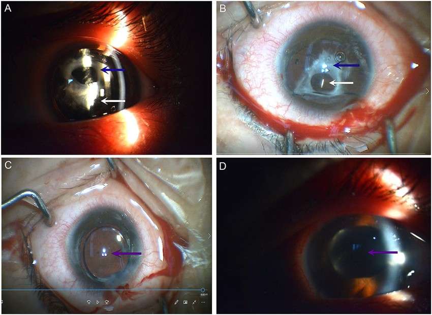 Diagnosis before ICL Surgery