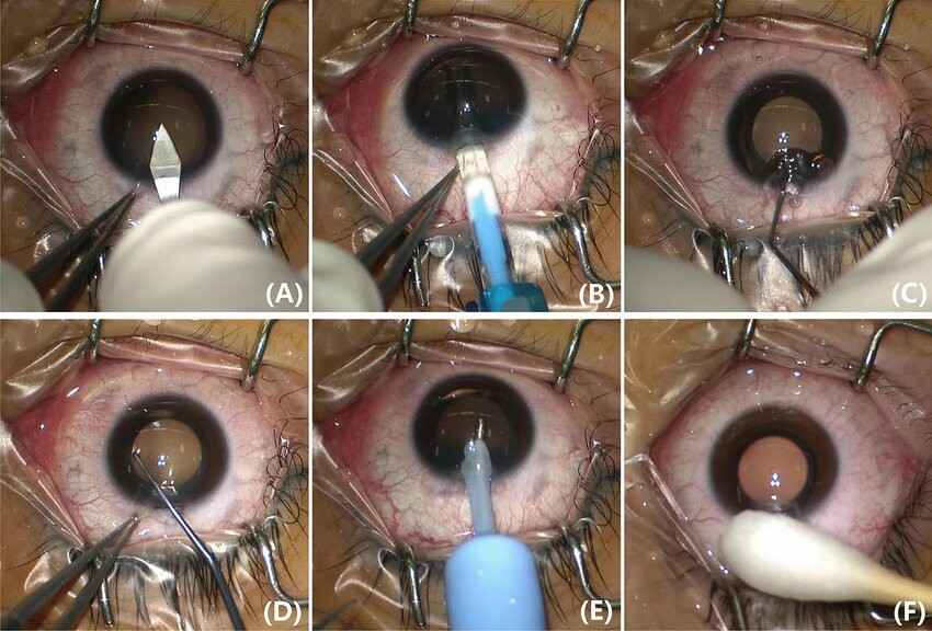 ICL Surgery Procedure