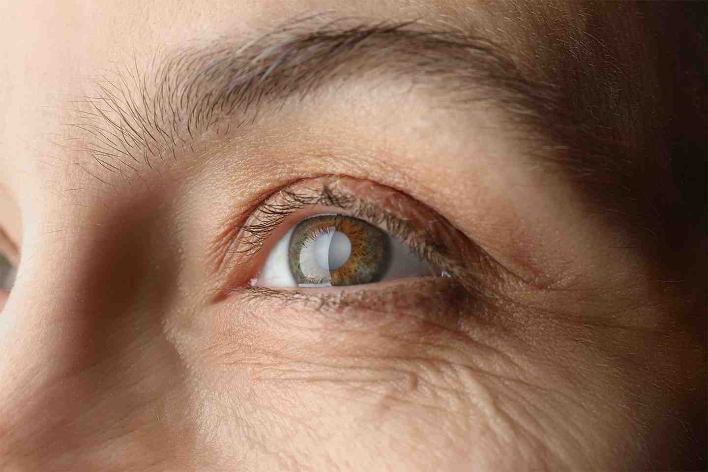 ICL Surgery Recovery