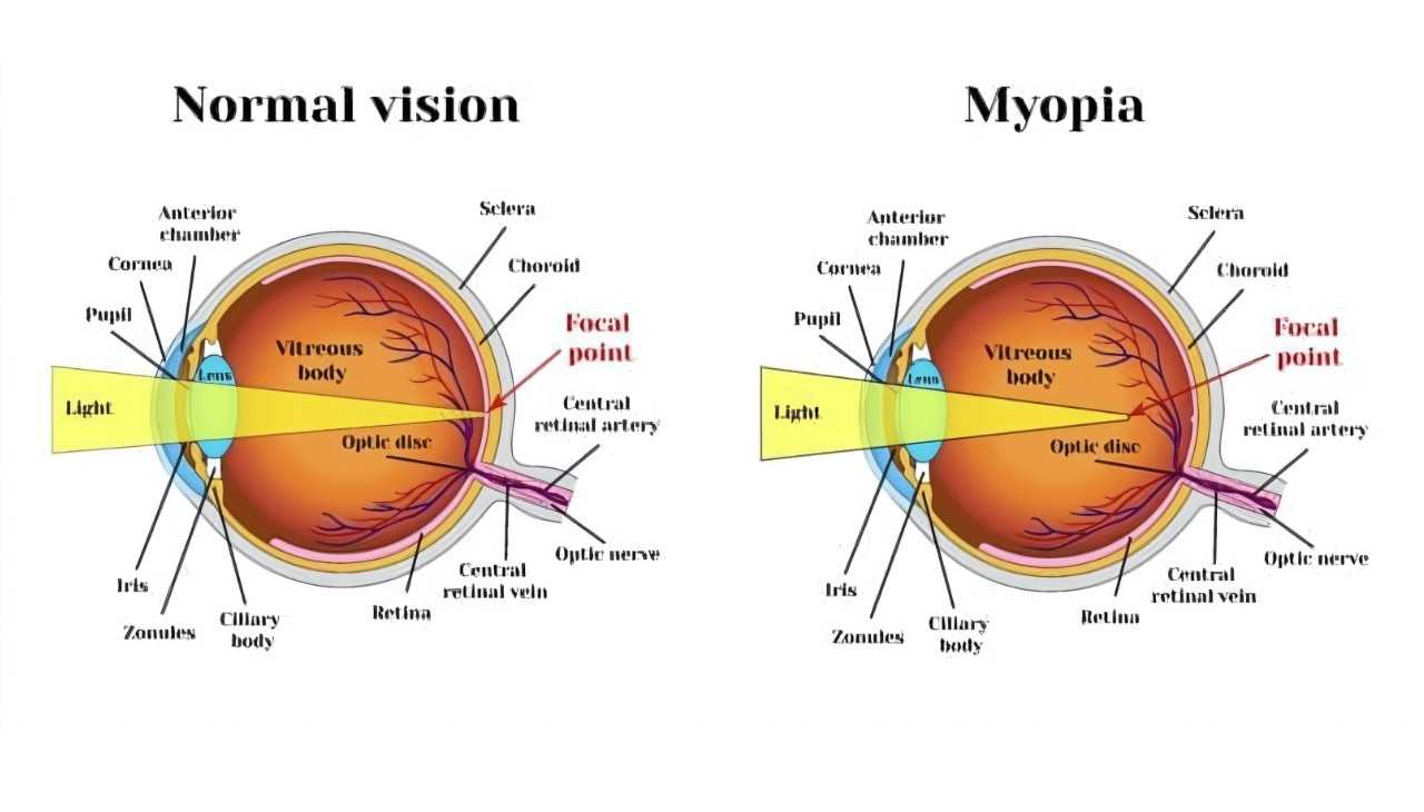 Types of ICL Surgery