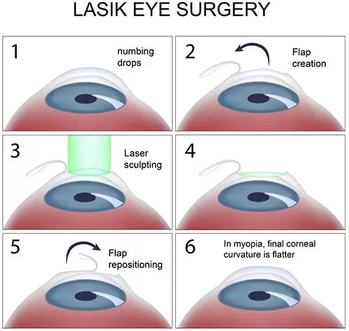 Benefits of LASIK Surgery