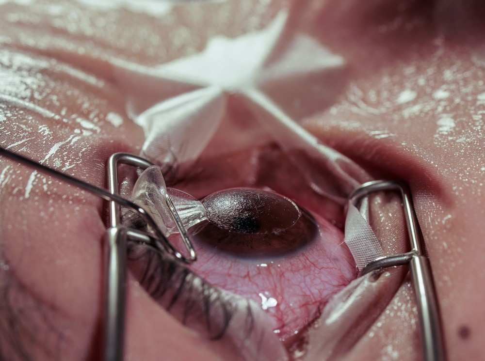 LASIK Surgery by Dr. Vishal Maniar