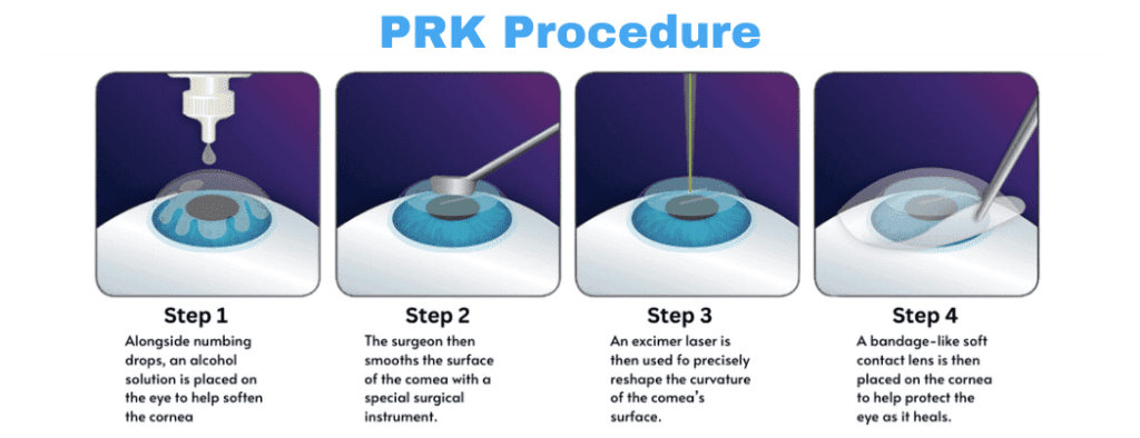 Types of LASIK Procedures