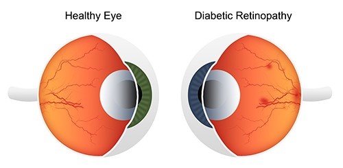 Causes of Low Vision