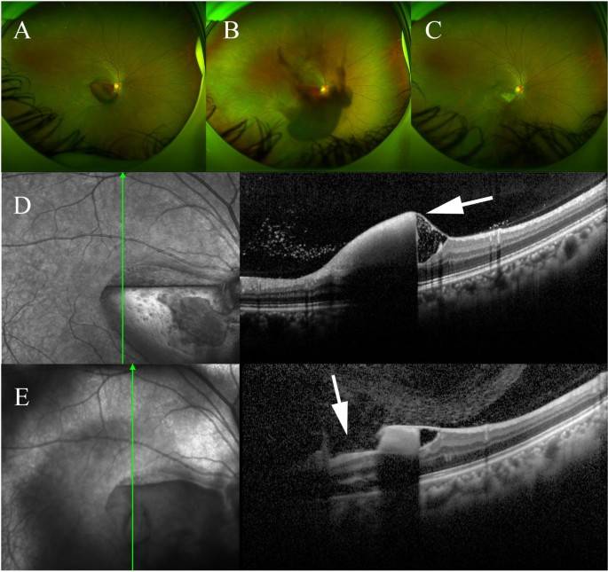 Eye Conditions Diagnosed with OCT & Treated with YAG