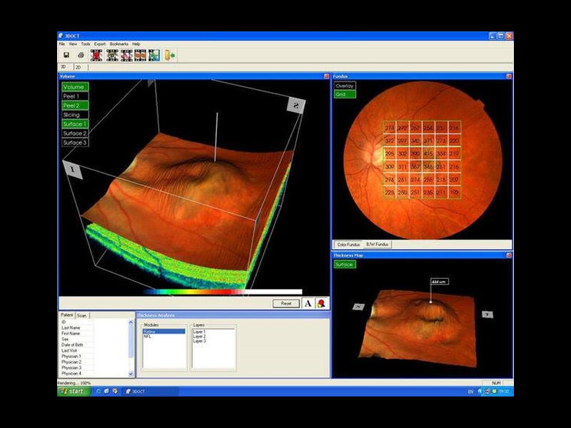 Benefits of OCT Scan and YAG Laser