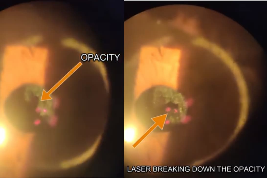 OCT Scan and YAG Laser Eye Conditions