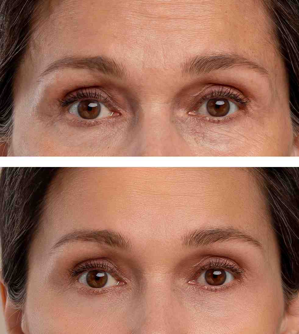 Benefits of Oculoplasty Surgery