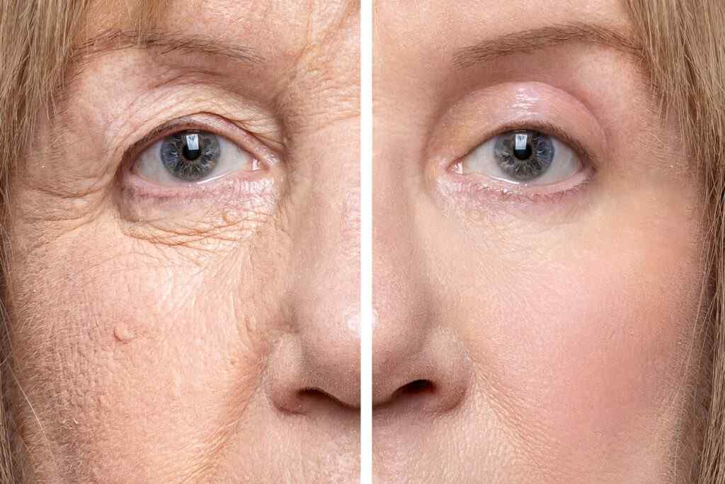 Candidate for Oculoplasty Surgery