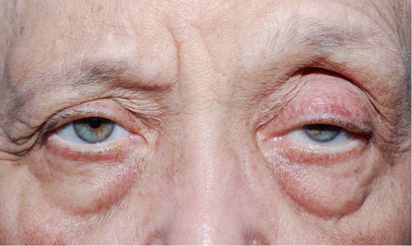 Diagnosis in Oculoplasty