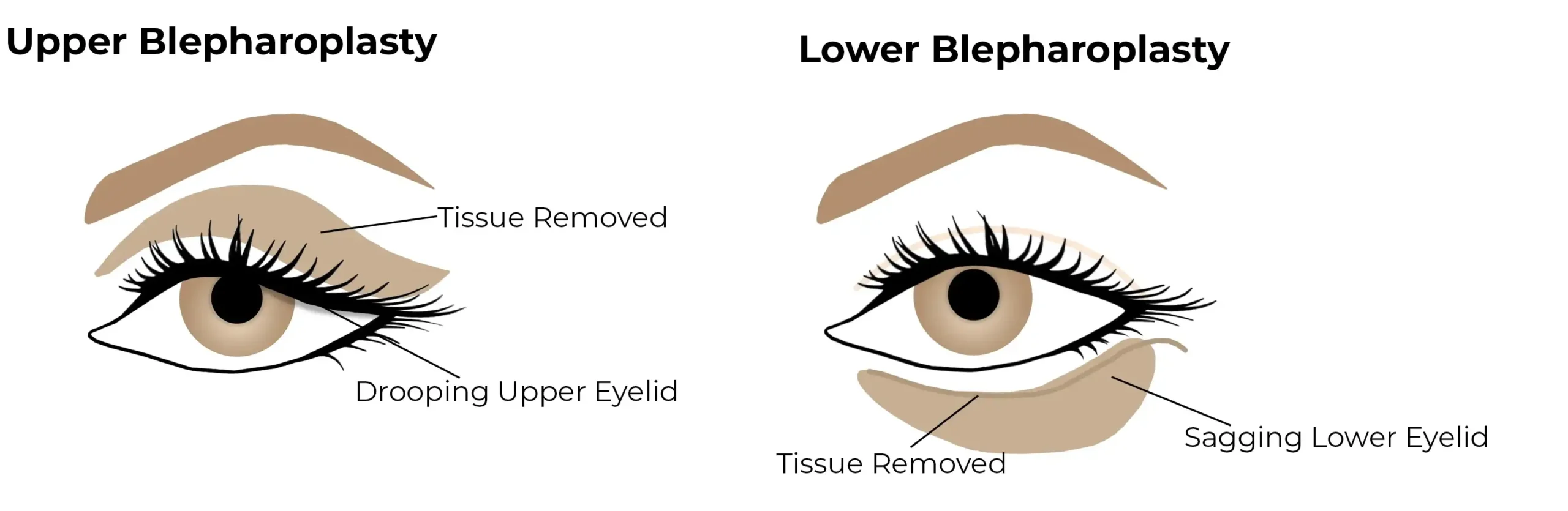 Types of Oculoplasty Surgery