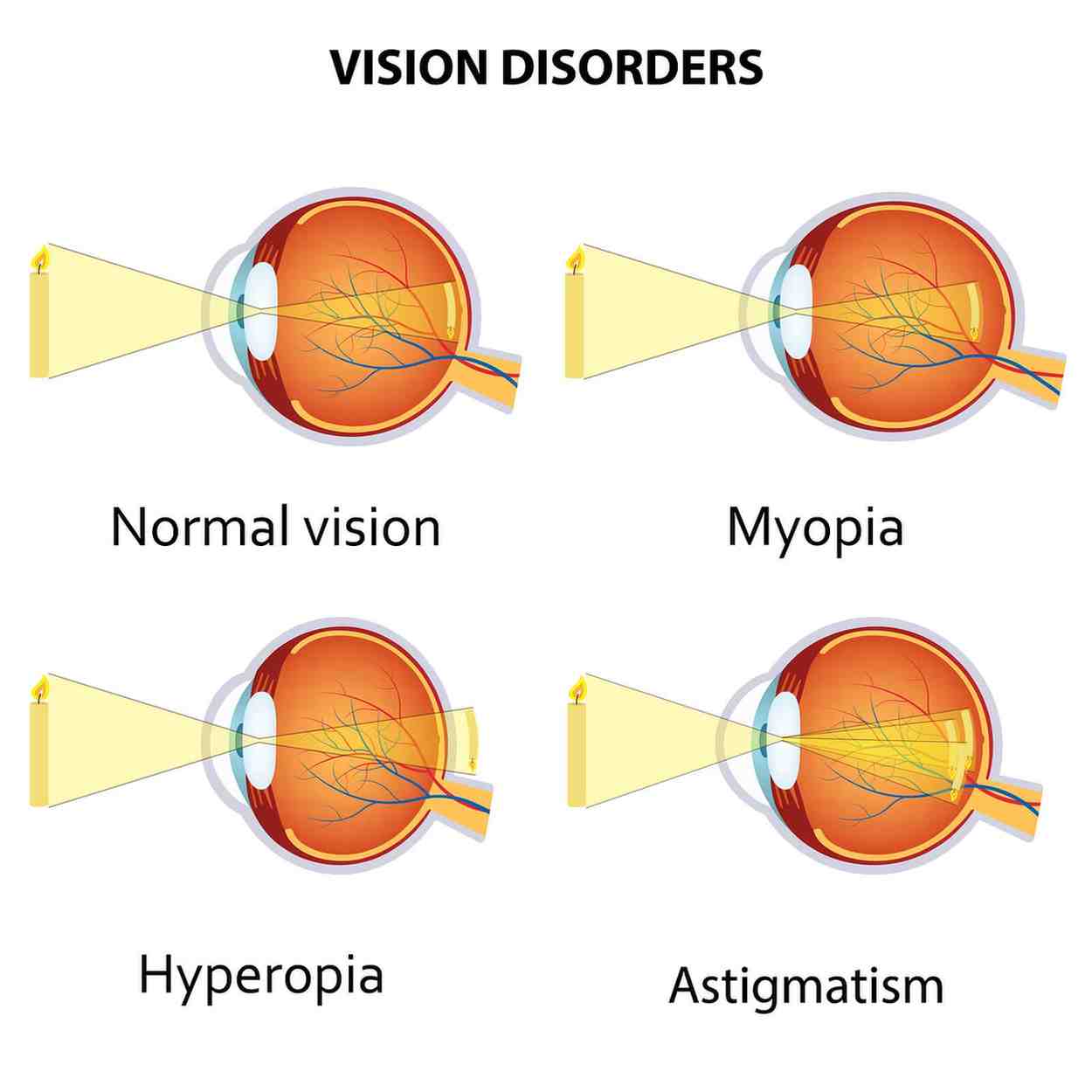 Causes of Pediatric Eye Problems