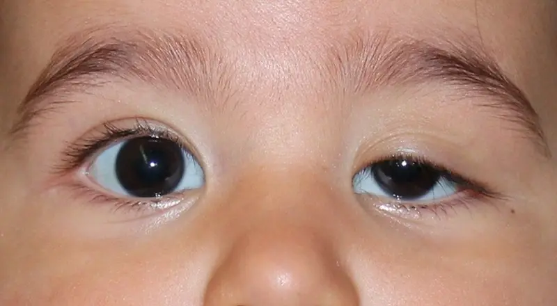 Common Pediatric Eye Problems