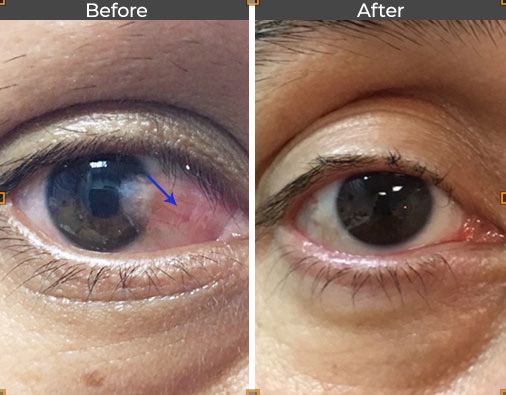 Benefits of Pterygium Surgery
