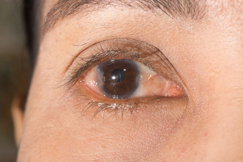 Causes of Pterygium