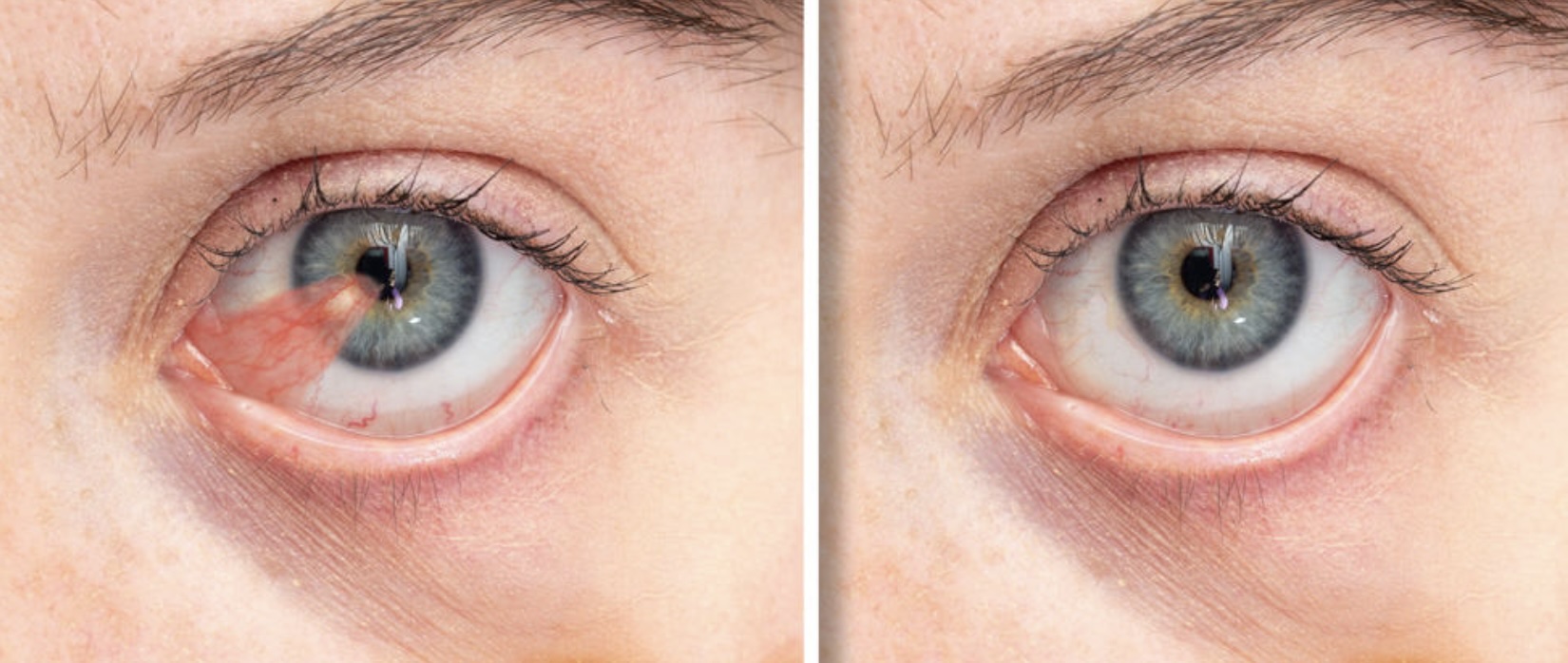 Pterygium Surgery Recovery