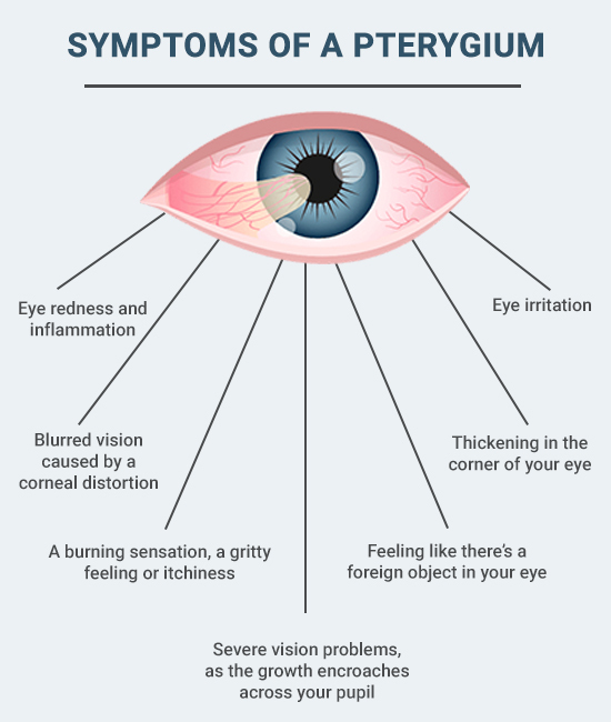 Symptoms of Pterygium
