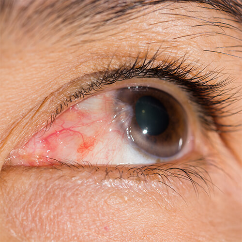 Pterygium Treatment Options