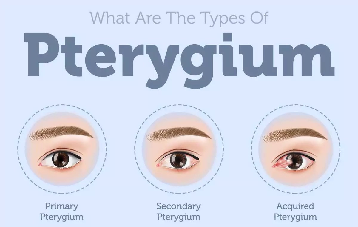 Types of Pterygium