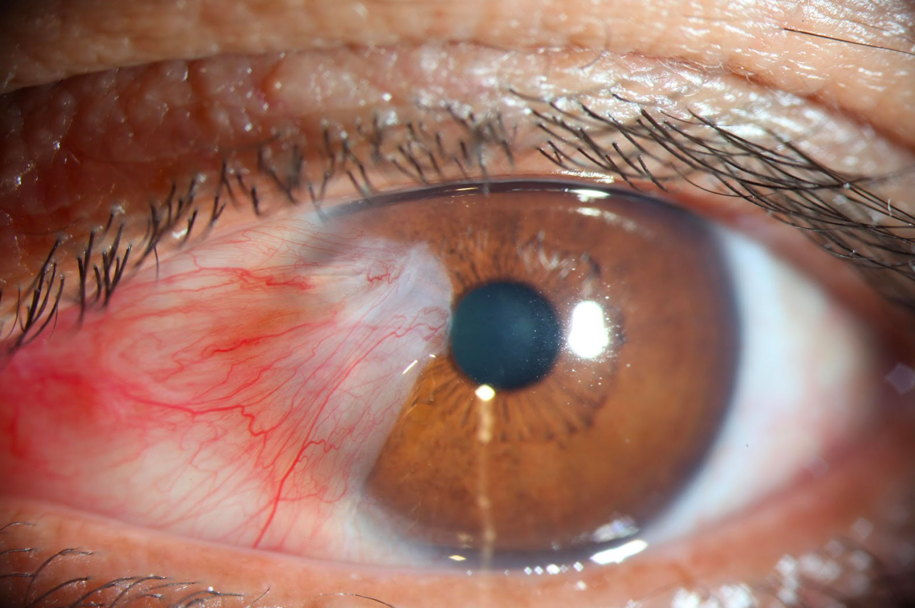 What is Pterygium Surgery