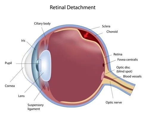 Causes of Retinal Problems