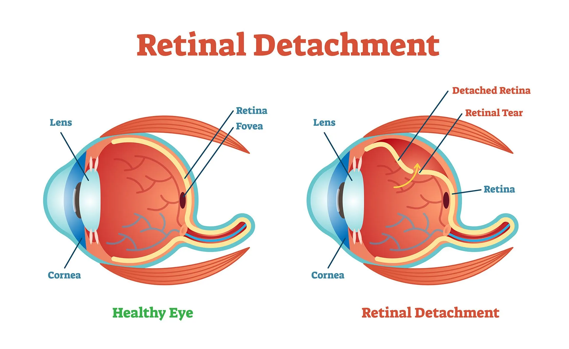 Retina Surgery Recovery