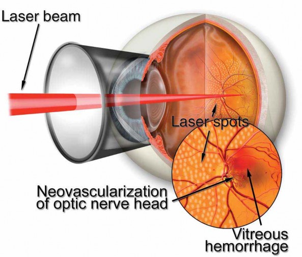 Retina Treatment Options
