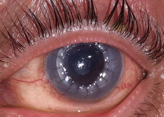 Cornea Surgery