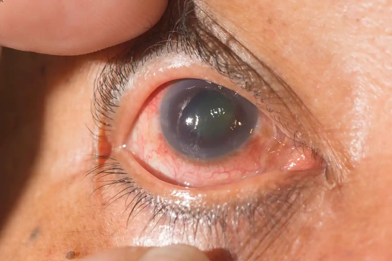 Glaucoma Surgery