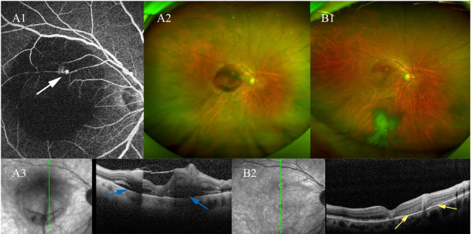 OCT Scan & YAG Laser