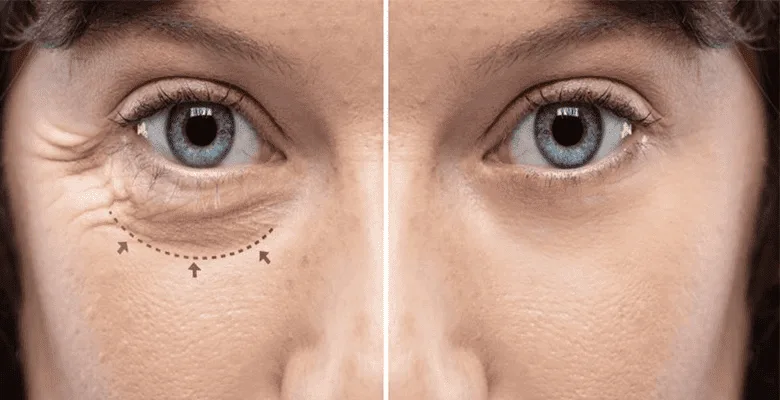 Oculoplasty Surgery
