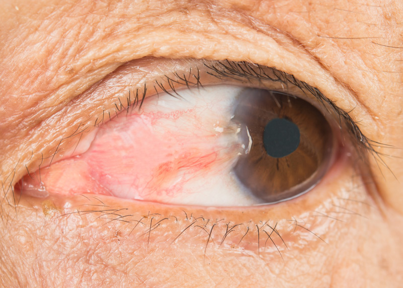 Pterygium Surgery